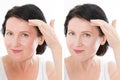 Middle age close up forehead woman happy face before after cosmetic procedures. Skin care for wrinkled face. Before-after anti- Royalty Free Stock Photo