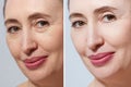 Middle age close up woman happy face before after cosmetic procedures. Skin care for wrinkled face. Before-after anti-aging