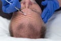 Middle aged caucasian man getting a wrinkle treatment on forehead