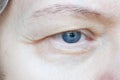 Middle aged female`s eye with drooping eyelid. Ptosis is a drooping of the upper eyelid, lazy eye. Cosmetology and facial concept