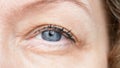 Middle aged female`s eye with drooping eyelid. Ptosis is a drooping of the upper eyelid, lazy eye. Cosmetology and facial concept