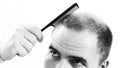 Middle-aged man concerned by hair loss Baldness alopecia close up black and white, white background Royalty Free Stock Photo