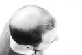 Middle-aged man concerned by hair loss Baldness alopecia close up black and white, white background Royalty Free Stock Photo