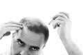 Middle-aged man concerned by hair loss Baldness alopecia close up black and white, white background Royalty Free Stock Photo