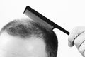 Middle-aged man concerned by hair loss Baldness alopecia close up black and white, white background Royalty Free Stock Photo