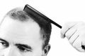 Middle-aged man concerned by hair loss Baldness alopecia close up black and white, white background Royalty Free Stock Photo