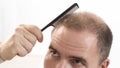 Middle-aged man concerned by hair loss Baldness alopecia close up white background Royalty Free Stock Photo