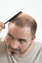 Middle-aged man concerned by hair loss Baldness alopecia close up white background Royalty Free Stock Photo