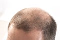 Middle-aged man concerned by hair loss Baldness alopecia close up white background