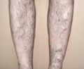 Legs of a man with varicose veins and capillaries Royalty Free Stock Photo