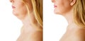 Woman before and after chin fat correction procedure Royalty Free Stock Photo