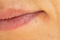 Middle aged woman`s corner of mouth with Herpes Labialis Royalty Free Stock Photo