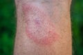 Migrating erythema after a tick bite on a man`s leg.