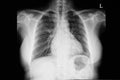 mild cardiomegaly