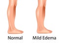 Mild edema with normal leg