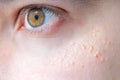 Milia (Milium) - pimples around eye on skin