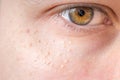 Milia (Milium) - pimples around eye on skin Royalty Free Stock Photo