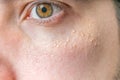 Milia (Milium) - pimples around eye on skin