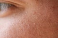 Milia Milium - pimples around eye on skin. Eyes of young man with small papillomas on eyelids or growths on skin