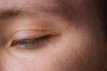 Milia Milium - pimples around eye on skin. Eyes of young man with small papillomas on eyelids or growths on skin