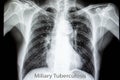 miliary pulmonary tuberculosis Royalty Free Stock Photo