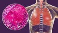 Miliary tuberculosis, illustration and light micrograph Royalty Free Stock Photo