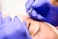 Milium on the face, removal of milia with a syringe in cosmetology. Royalty Free Stock Photo