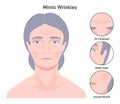 Mimic wrinkles. Age-related skin changes. Aging process, forehead