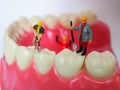 Miniature worker on plastic teeth of removable denture. Dental h