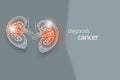 Cancer kidney disease or renal cell carcinomas. Malignant kidney tumors.