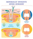 Minimally invasive spine surgery vector illustration. Labeled diagram. Royalty Free Stock Photo