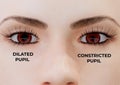 Miosis is a condition in which one or both pupils constrict, regardless of how much light enters the eye Royalty Free Stock Photo