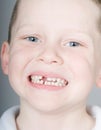 Missing front tooth Royalty Free Stock Photo