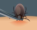 Mite parasites. Tick parasite removing by tweezers vector illustration. Mite parasites. Acarus. Mite spider. Mite