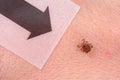 Mite on the skin. Danger of tick bite Royalty Free Stock Photo