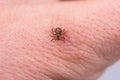 Mite on the skin. Danger of tick bite. Royalty Free Stock Photo