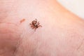 Mite on the skin. Danger of tick bite. Royalty Free Stock Photo