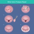 Mitral Valve Prolapse Repair. The method repair heart valve by surgery removed damaged or abnormal leaked segment and used