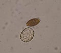 Mixed Ascaris lumbricoides and Trichulis trichiura egg in stool examination