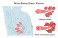 Mixed breast carcinoma. Detailed breast medical anatomy with lactiferous