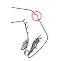 Simple vector black outline drawing. Hygroma on the wrist joint. Subcutaneous formation on the hand. Medicine, health, surgery.