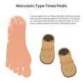 Moccasin type tinea pedis athlete\'s food education vector infographic