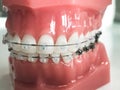 Model of human jaw with wire braces attached. Dental and orthodontic office and lab presentation tool, dental care and