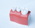 This model shows that teeth have been capped and the stainless pin in the gums.