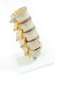 Model of spinal disc herniation Royalty Free Stock Photo