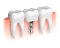 Model of teeth and dental implant Royalty Free Stock Photo