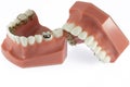 Model of Teeth with Lingual Braces Royalty Free Stock Photo