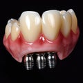 Model with titanium metal screw implant,Dentists dental prosthetic teeth, gums, AI generated