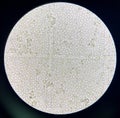 Moderate bacteria and white blood cells in urine