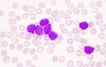 Moderate blast cell of white blood cells in blood smear